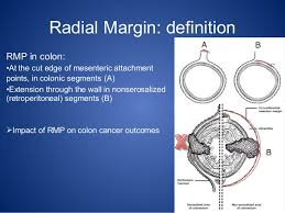 Usually notes about samples that have been sent for other tests or a second opinion Radial Margin Positivity As A Poor Prognostic Factor For Colon Cancer