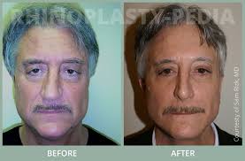 View NYC Male Rhinoplasty Patients Before And After Photos