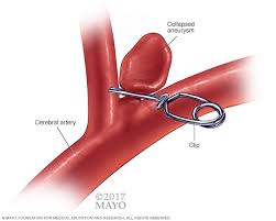 Aneurysms can also be a nidus (starting point) for clot formation (thrombosis) and embolization. Brain Aneurysm Diagnosis And Treatment Mayo Clinic