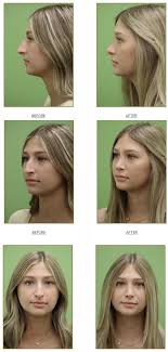 Primary Rhinoplasty Rhinoplasty Rhinoplasty Nose Jobs Plastic Surgery