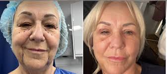 Hi I'm looking for recommendations for facelift in UK or Turkey preferably  but I'd appreciate anyones recommendations ty