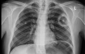 Cerebral venous sinus die ct und die mrt, jeweils mit angiographie, sind bei der diagnostik der sinusthrombosen. Klinikum Wilhelmshaven