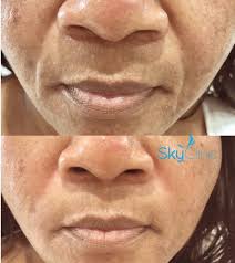 The nasolabial folds are lines located on either side of the mouth. Nasolabial Folds Smile Lines 1ml Juvederm Volift Sky Clinic