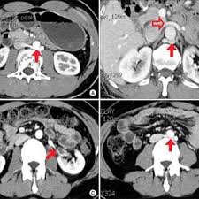 Pdf The Clinical Significance Of A Retroaortic Left Renal Vein