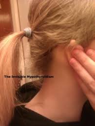 In one study of 25 patients diagnosed with hypothyroidism, researchers found hair symptoms were present in 68% of patients. Hypothyroidism And Hair Loss