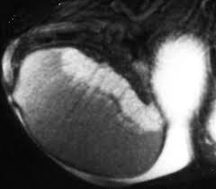 Tubular ectasia of the epididymis results in enlargement of the epididymis with multiple cystic interfaces. Us Mr Imaging Correlation In Pathologic Conditions Of The Scrotum Radiographics