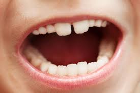 Sie füllen eine lücke im kiefer hinter dem bisher letzten milchzahn. Zahnpflege Bei Kindern Vom Ersten Zahn An Sauber Stern De