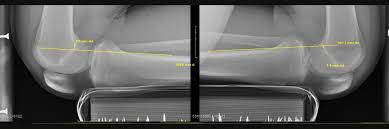 Image result for PCL Sulcus Test