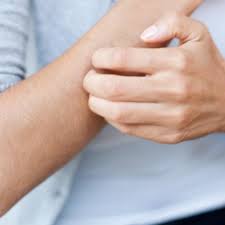 Mosquito Bites Treat Itching And Recognize Infections Alliance Work Partners
