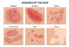 Image result for Skin Infection