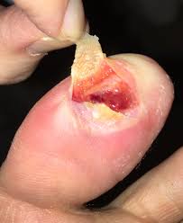 I have slowly broken my ankle grow walking on the side of my foot those things hurt dammit. My Blister From The Beetlejuice Popped I Peeled The Top Of The Wart Back And It Was Larger Than I Anticipated I M Going To Pour Peroxide On It Next And Then Apply