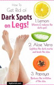 Jun 30, 2020 · how to get rid of marks left by mosquito bites, according to doctors wear sunscreen. How To Get Rid Of Dark Spots On Legs Beautytipsbody Dark Spots On Skin Dark Spots On Legs Spots On Legs