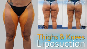 Lipo 360 Legs Thigh Knee Liposuction Lipedema Surgery Expert Dr In 2020 Lipedema Lipedema Treatment Liposuction