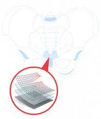 Transvaginal Mesh What Is Transvaginal Mesh Used For