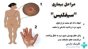 عکس بیماری سفلیس در زنان+بهترین دارو برای درمان سفلیس