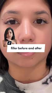 who else had a temporary lisp after chin filler or just me? #chinfille...