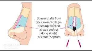 My nose is similar to the african american woman's whereby. Nasal Valve Collapse Repair