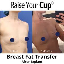 Image result for Breast Augmentation