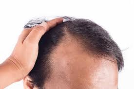 Look into taking vitamins and supplements for some added hair growth support. 5 Best Ways To Stimulate Hair Growth With Vitamins Pure Naturals
