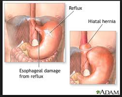 Pin On Stop Acid Reflux Now