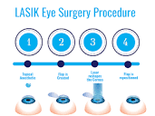 Understanding Hyperopia and LASIK Eye Surgery