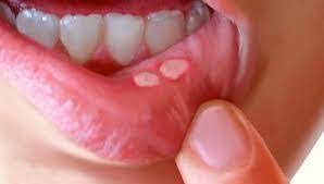 Cara hilangkan bau mulut semasa berpuasa. 6 Cara Berkesan Untuk Merawat Rohaya Dental Surgery Facebook