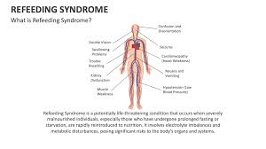 Image result for Refeeding Syndrome