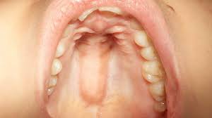 In the roof of the mouth toward the anterior there is sometimes a series of ridge formed by the mucosal folds, these are called ruggae. Torus Palatinus Symptoms Diagnosis Causes And More