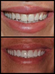 So we've gathered some great quotes about smiling to boost your mood and bring a few more smiles to your. Smile Spotlight Charlene I Used To Hate My Smile Not Anymore