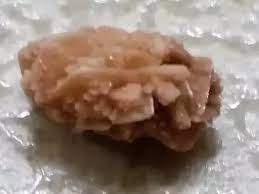While a kidney stone passing and reaching the very end of the ureter, the patient may alter how s/he urinates and thereby feel some degree of urinary. What Are The Treatments For A 9 Mm Kidney Stone Quora