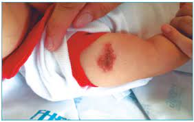 Scielo Brasil Diagnostic Value Of The Reaction At The Bacillus Calmette Guerin Vaccination Site In Kawasaki Disease Diagnostic Value Of The Reaction At The Bacillus Calmette Guerin Vaccination Site In Kawasaki Disease