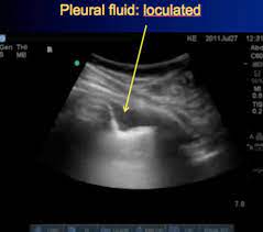 Check spelling or type a new query. What Is Loculated Pleural Effusion Loculated Right Pleural Effusion With Pleural Enhancement Pleural Effusions Compromise Lung Function By Preventing Its Kumpulan Alamat Grapari Telkomsel Dan Alamat Bank