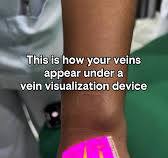 This is how your veins appear under a vein visualization device | Nurse  Darwin | Facebook