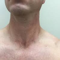 Medullary thyroid cancer is the only thyroid cancer that develops from parafollicular cells. Testimonials And Great Stories From Thyroid Patients Of Gary Clayman Md