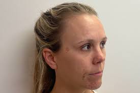 Image result for Solar Lentigo