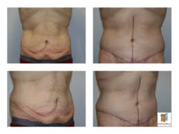 Search for pictures tummy tuck at sprask. Body Cosmetic Surgery Before And After Photos