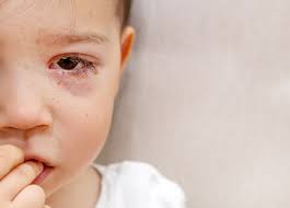 Image result for Bacterial Conjunctivitis