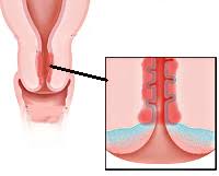 Cervicita candidozică indică faptul că inflamaţia colului uterin a apărut pe fondul infecţiei fungice (detalii despre aceasta le găsiţi în articolul: Prevenirea È™i Tratamentul Exo EndocervicitÄƒ ColpitÄƒ È™i CervicitÄƒ Cauze Simptome Diagnostic È™i Tratament