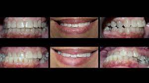 In addition to dental correction, braces can also achieve a degree of skeletal realignment when paired with elastics, expanders and other appliances. Invisalign For Treating Crossbite At Cosmetic Dental Associates San Antonio Tx Dentist Office Youtube