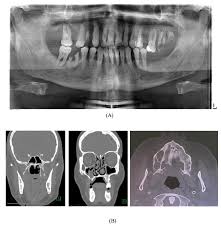 Image result for granuloma gum disease