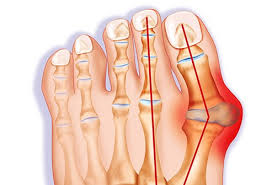 Significant foot pain that limits their everyday activities, including walking and wearing reasonable shoes. What You Should Do After Bunion Surgery