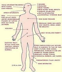 The disease, which gets worse over time, attacks motor control regions of the brain (those involved with movement), as well as other areas. Huntington S Disease Huntington Disease Genetic Disorders Huntington