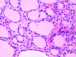 Maybe you would like to learn more about one of these? Thyroid Cancer Knowledge Amboss