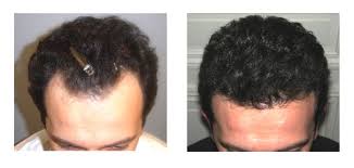 Before And After Ihrf Formula Best Hair Loss Treatment In Men And Women For Hair Re Growth Http Best Ha Hair Loss Treatment Hair Growth Treatment Hair Loss