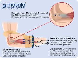 Informationen Video Und Wirkprinzip Tennisarm Tennis Arm Gesundheit