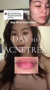 Isotretinoin Acne Journey: Day 10 Insights