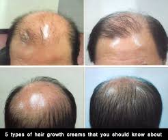 Best 5 Hair Growth Creams 2020 Hair Growth Concern