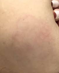 However, after i get the clog out the mastitis remains. Mastitis Redness Babycenter