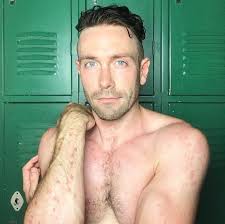 Many of you probably don't know that I struggle with #Psoriasis, because  I've been lucky enough to not have had an outbreak in a few years. But this  month it came roaring