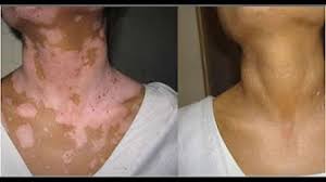 Weisse Flecken Am Korper Hautpilz Braune Flecken Homoopathie Pigmentflecken Im Gesicht Youtube